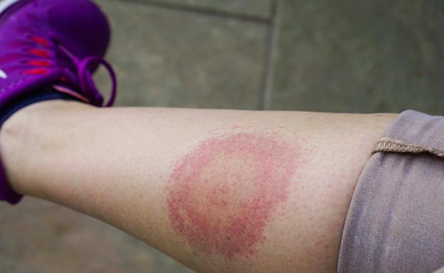 La enfermedad de Lyme es transmitida por la picadura de garrapatas infectadas./
